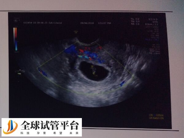 孕早期做阴道B超很有必要