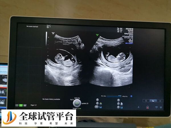 双胞胎不是试管婴儿的适应症