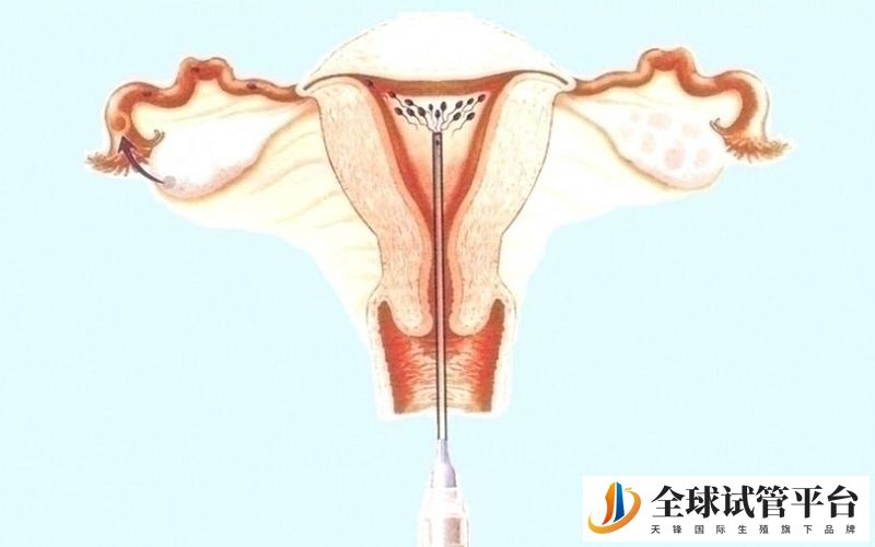 国内赴加拿大做人工授精多少钱一次？