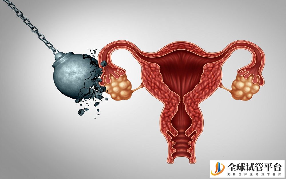 巧克力囊肿的注意事项