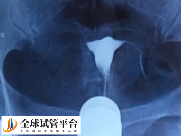 无输卵管可做试管