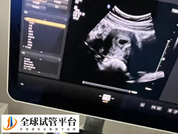 黄体功能不足会导致FSH偏高