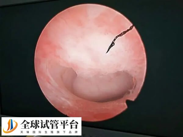 内膜出现病变会影响内膜厚度