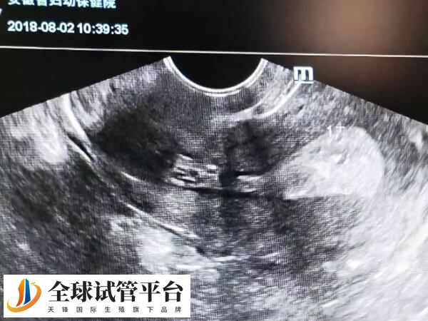 内膜厚度小于8mm不适合移植鲜胚