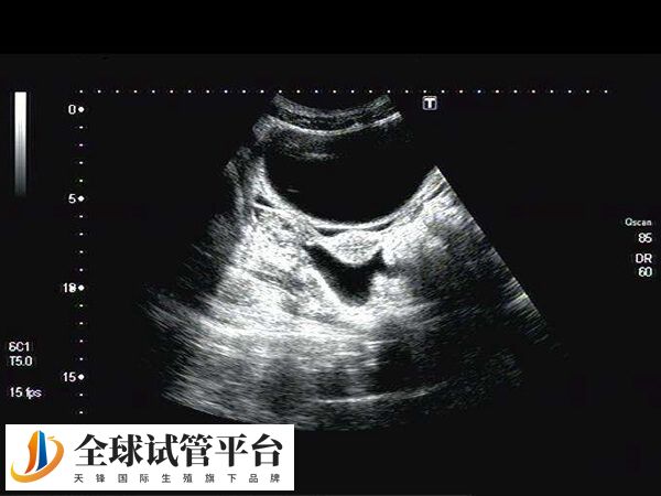 三线型子宫内膜更适合胚胎移植