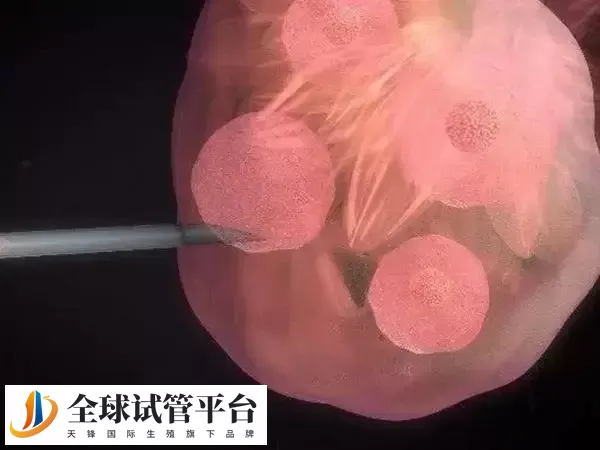 俄罗斯取卵有什么风险 取卵会不会痛