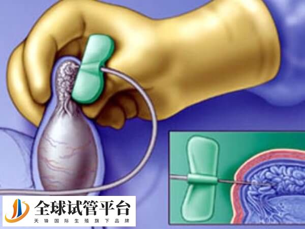 荆州一医生殖中心做试管婴儿男性怎么取精子？