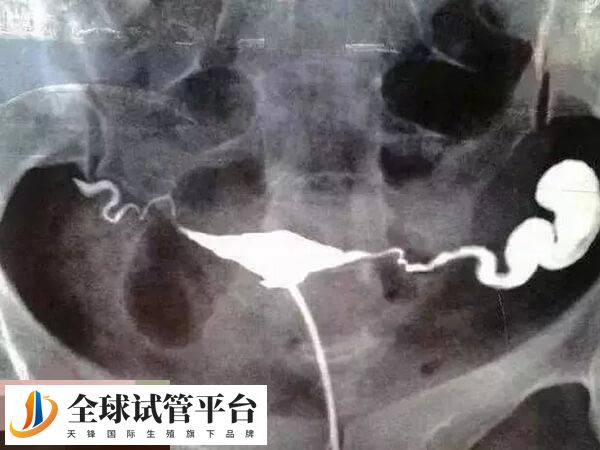 输卵管积水含微生物碎屑等有害物质多