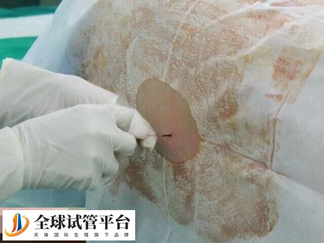 宫腔镜是一种微创性妇科诊疗技术