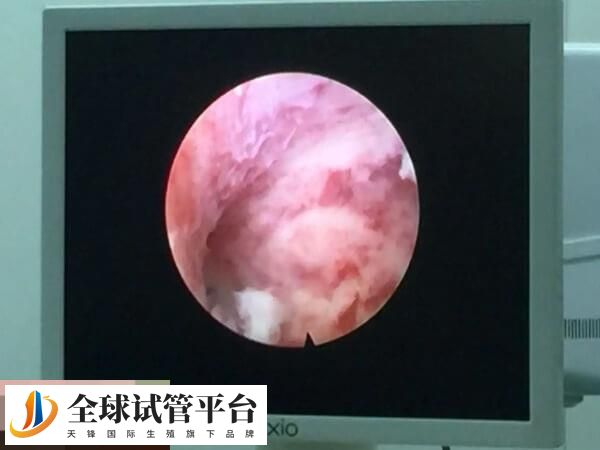 宫腔镜可以确诊宫腔疾病