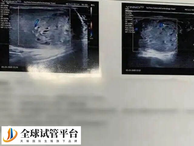 子宫内膜的厚度对于试管的成功至关重要