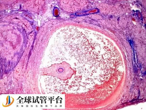 空卵泡中没有可用卵子