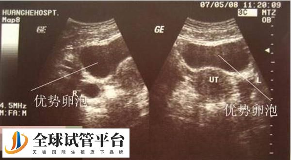 25个卵泡可以进行促排卵