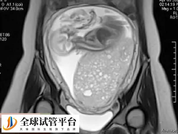 葡萄胎出现的几率是不可控的