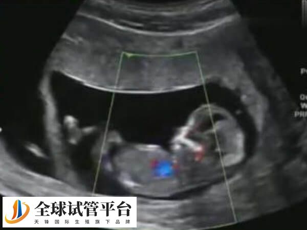 试管移植后定期产检是关键