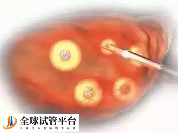 取卵是在超声下穿刺抽吸卵泡的一种手术
