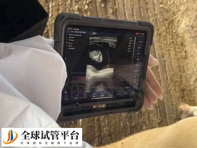 B超监测排卵需要多次往返医院