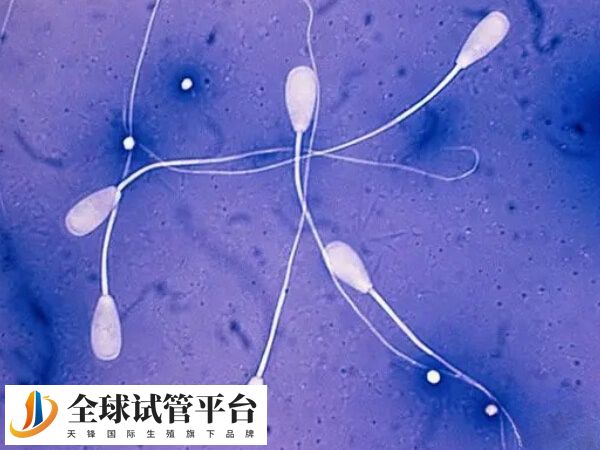 甲亢全称为甲状腺功能亢进症