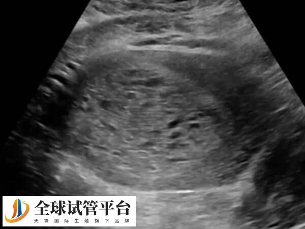 尿崩症患者主要表现为多尿的症状