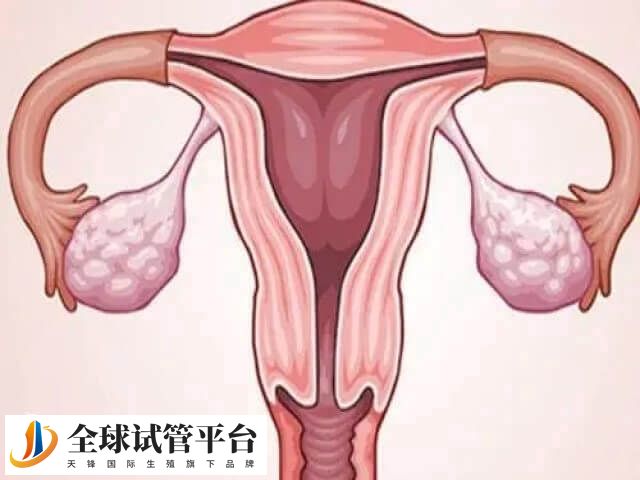子宫内膜异位症是一种女性常见妇科疾病