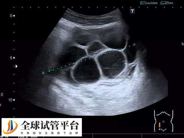 取卵后有淤血流出可能是卵巢过度刺激