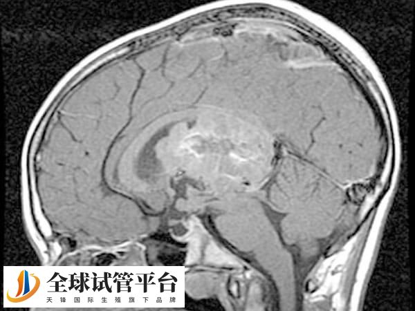 三叉神经鞘瘤患者并非完全不能做试管婴儿
