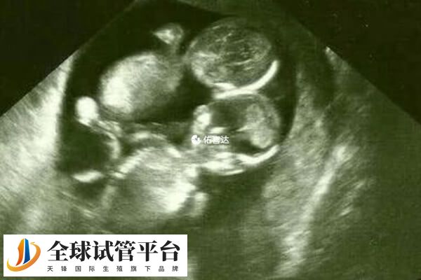 三胎减胎手术的成功率通常在90%左右