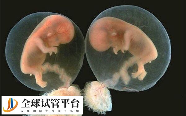 孕妇身体健康不需要做减胎手术