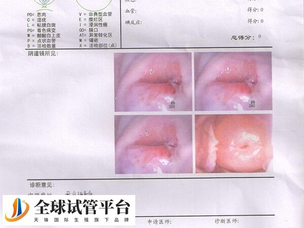 宫颈糜烂能否做试管婴儿
